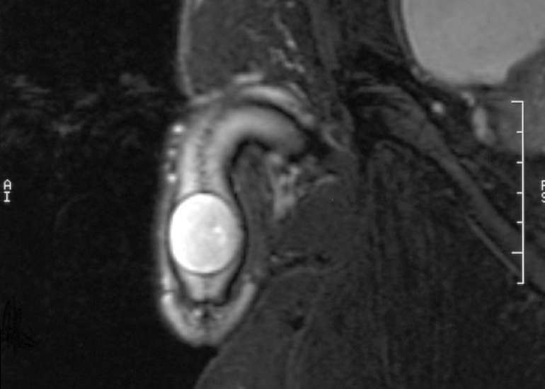 Pediatric leiomyoma of the glans